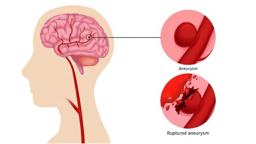 Dấu hiệu tiềm ẩn cảnh báo bệnh phình động mạch não