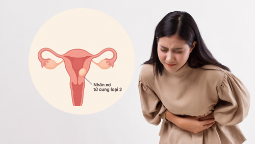 Cách kiểm soát nhân xơ tử cung loại 2 để tránh biến chứng