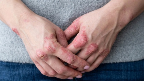 Giải pháp cho người vảy nến đang điều trị bệnh dạ dày