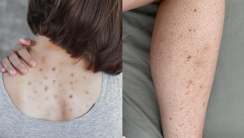 Giải pháp giúp làn da cơ thể mịn màng, hết mụn