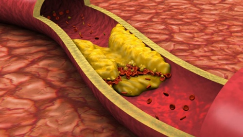 5 cách cải thiện mỡ máu cao hiệu quả