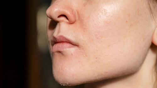 Cần làm gì khi da mặt bị bong tróc vào trời lạnh?