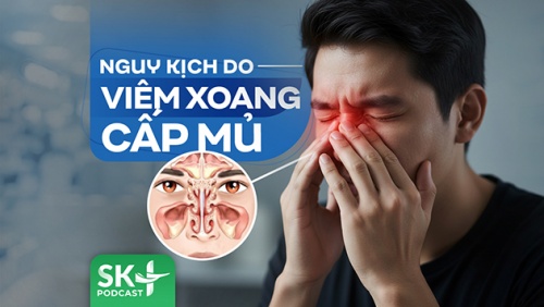 Podcast: Nguy kịch do viêm xoang cấp mủ
