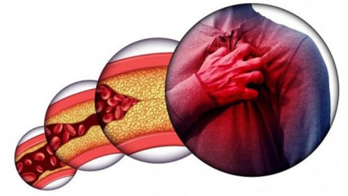 Mỡ máu cao - “thủ phạm” gây đột quỵ, nhồi máu cơ tim