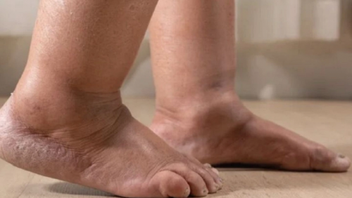 Sưng tấy bàn chân kéo dài cảnh báo dấu hiệu bệnh lý gì?