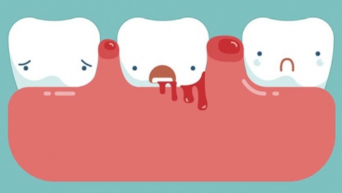 Cách cải thiện tình trạng chảy máu chân răng
