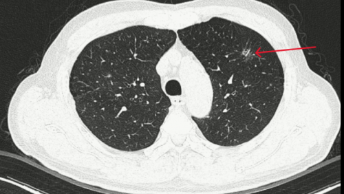 Đi khám sỏi thận, phát hiện ung thư phổi giai đoạn sớm nhờ AI