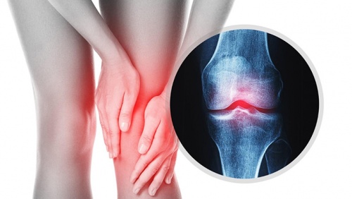 Đau xương khớp cảnh báo bệnh gì?