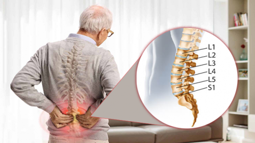 Dấu hiệu nhận biết thoái hóa đốt sống lưng L5 S1 không nên bỏ qua
