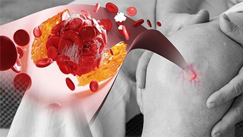 Yoga có giúp kiểm soát acid uric cao không?