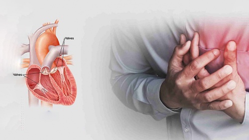 Hẹp van tim do thấp tim: Nguy cơ tiềm ẩn ở người trẻ