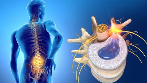 7 nguyên nhân dẫn đến thoát vị đĩa đệm