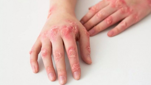 Người bệnh lupus ban đỏ nên ăn gì để kiểm soát triệu chứng tốt?