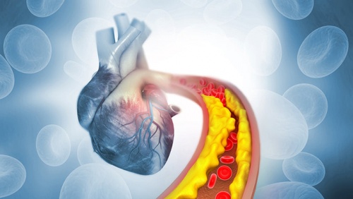 Tăng huyết áp kèm cholesterol cao: “Bộ đôi” đẩy nhanh xơ vữa mạch