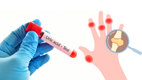 8 thói quen nhỏ giúp kiểm soát acid uric cao