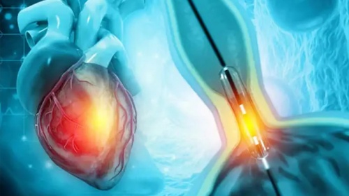 Hẹp mạch vành sau khi điều trị có tự hồi phục hoàn toàn không?