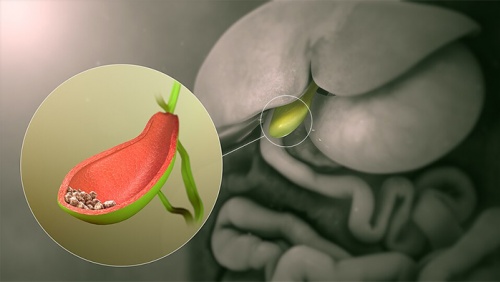 Tán sỏi qua da dễ tái phát phải làm sao?