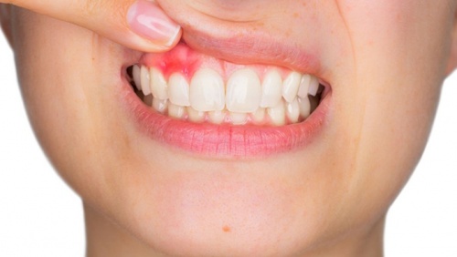 “Thủ phạm” gây viêm lợi và cách phòng ngừa thế nào?