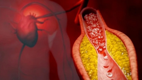 Xơ vữa động mạch - “Kẻ giết người thầm lặng” và giải pháp phòng ngừa hiệu quả