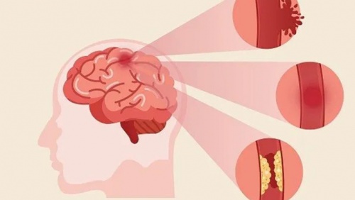 Dấu hiệu tai biến mạch máu não thường bị bỏ qua 