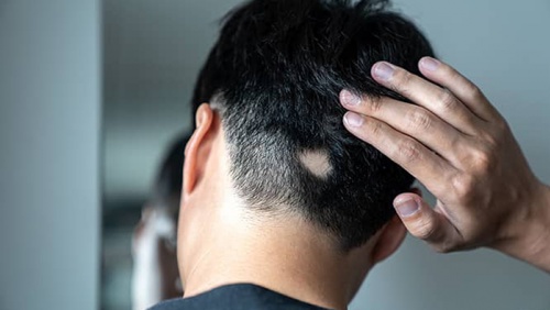 Lầm tưởng thường gặp về chứng rụng tóc từng mảng