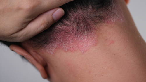 Vảy nến da đầu dễ tái phát, cải thiện ra sao?