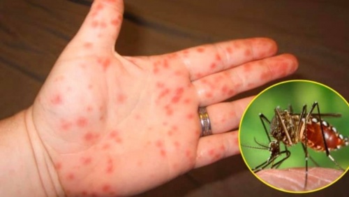 Sốt xuất huyết, tay chân miệng nặng tăng cao, Bộ Y tế cảnh báo khẩn