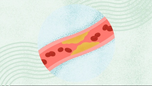 Bạn có thể mắc bệnh mạch vành dù không hề bị đau tức ngực?