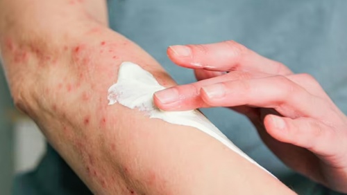 Dấu hiệu thường gặp của bệnh zona