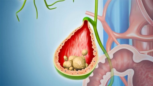 Khi nào sỏi túi mật 17mm trở thành vấn đề đáng lo ngại?