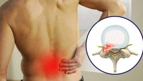 Thói quen hàng ngày khiến bệnh thoát vị đĩa đệm nặng hơn