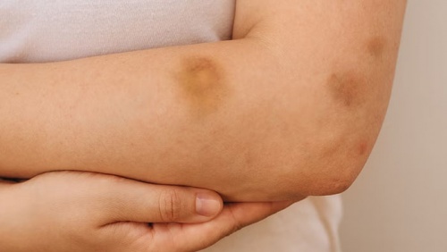 Hay bầm tím, cẩn thận thiếu vi chất