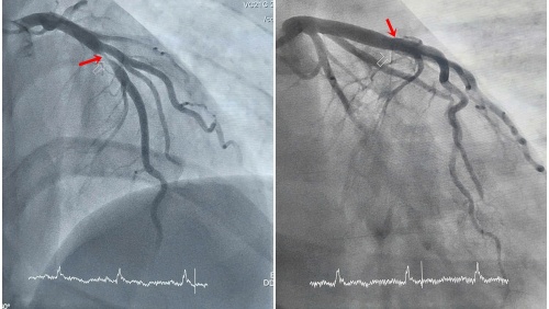 Thanh niên 29 tuổi phát hiện nhồi máu cơ tim cấp khi đi nội soi dạ dày
