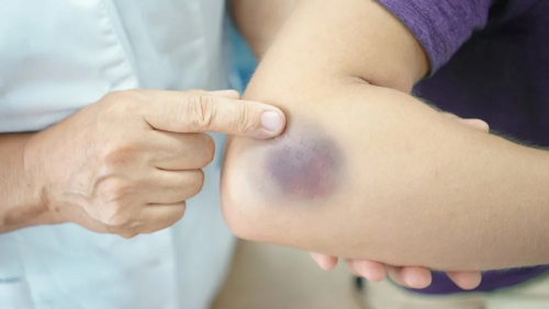 Dễ bị bầm tím, vì bạn đang thiếu loại vitamin này 