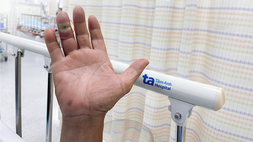 Nguy cơ nhiễm trùng nặng từ vết chó cắn