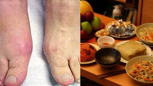 Mẹo để ngăn bệnh gout “ghé thăm” ngày Tết