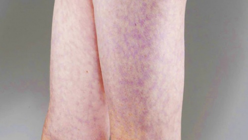 Dấu hiệu lạ trên da có thể cảnh báo vấn đề tim mạch