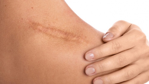 Cùng là vết thương, vì sao mặt ít sẹo hơn cơ thể?