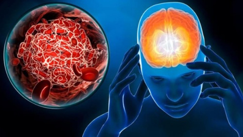 Nguyên nhân tai biến mạch máu não và cách phòng ngừa hiệu quả