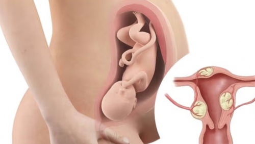 U xơ tử cung có gây khó mang thai không?