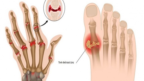 Chế độ ăn uống giúp giảm acid uric