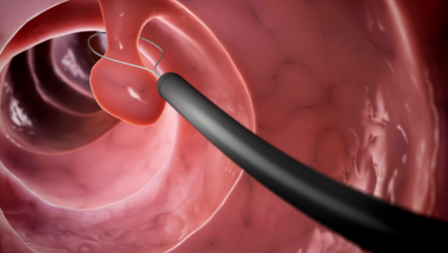 5 cách bảo vệ đại tràng, hạn chế nguy cơ ung thư từ polyp