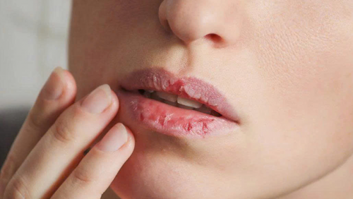 Giải pháp cải thiện tình trạng môi khô, nứt nẻ