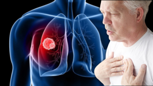 Cách kiểm soát triệu chứng khó thở do u phổi