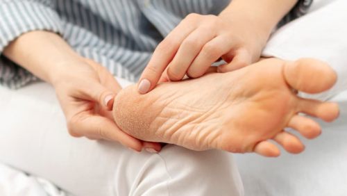 Cải thiện tình trạng nứt nẻ gót chân trong 4 bước