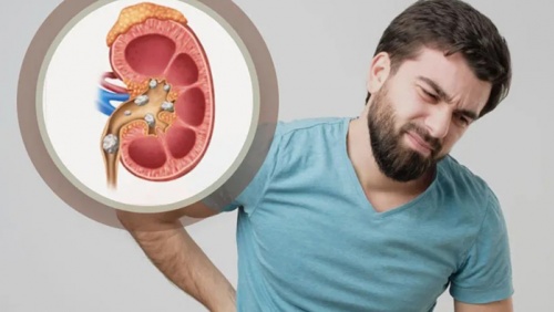 Vì sao nam giới dễ bị sỏi thận hơn nữ giới?