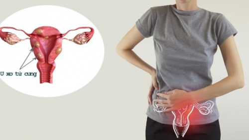 U xơ tử cung có gây hiếm muộn không?