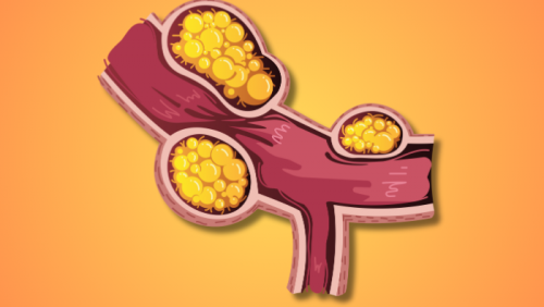 Xơ vữa động mạch: Nguyên nhân, mức độ nguy hiểm và giải pháp hỗ trợ phòng ngừa