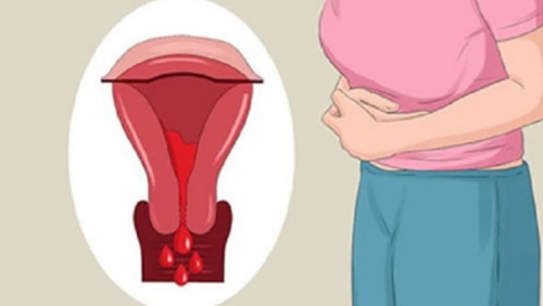 Dấu hiệu u xơ tử cung dưới niêm mạc giúp chị em “bắt” bệnh sớm