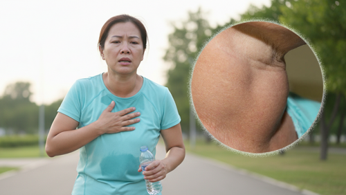 Khả năng vận động suy giảm vì bướu cổ do thiếu iod